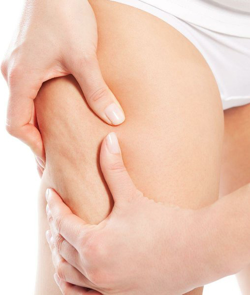 what is cellulite