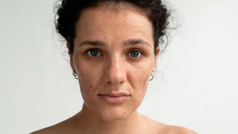Enlarged pores hero