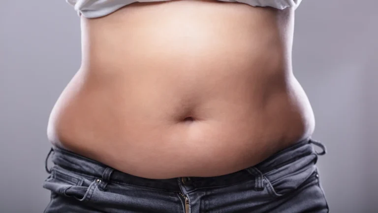 Localised fat deposits featured image