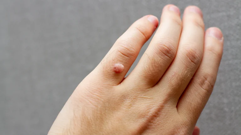 Warts Featured image