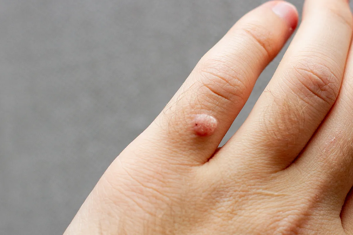 Warts supporting image